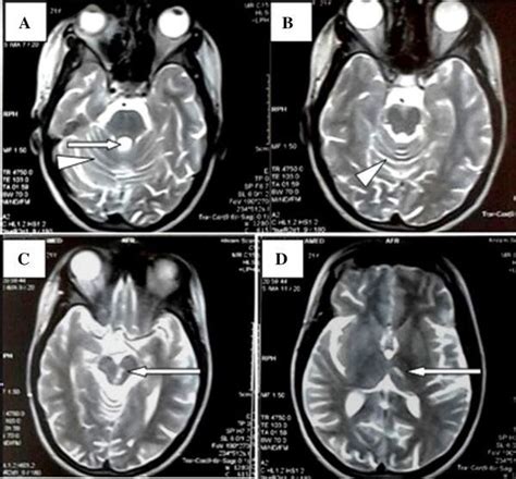 Brain Mri T2 Images A B Evidence Of Cerebellar Atrophy Dilated 4th