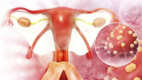 Cáncer De Ovario Síntomas Y Prevención Dra Marta Sánchez Dehesa