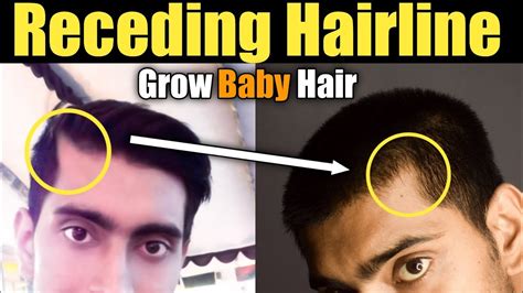How To Stop Hairfall And Receding Hairline Naturally At Home Grow