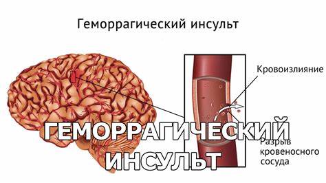 Геморрагический инсульт диета Геморрагический инсульт - YouTube Геморрагический инсульт - YouTube Геморрагический инсульт диета