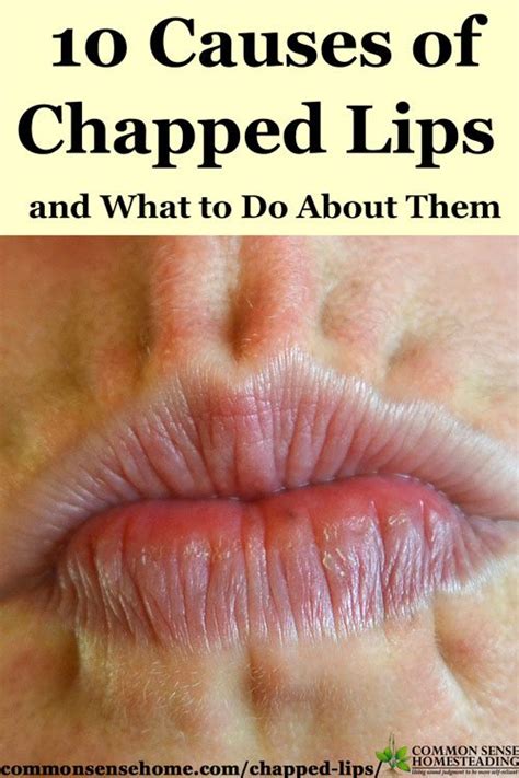 10 Causes Of Chapped Lips And What To Do About Them Total Survival