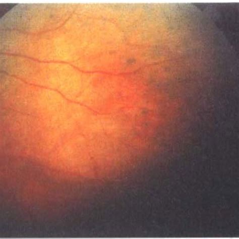 Pdf Sorsbys Fundus Dystrophy A Case Report Of 24 Years Follow Up