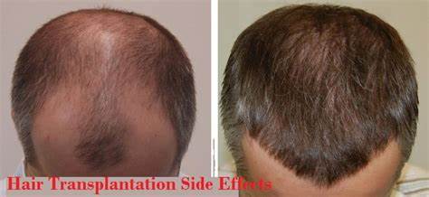 Symptoms Of Hair Transplantation You Must Know
