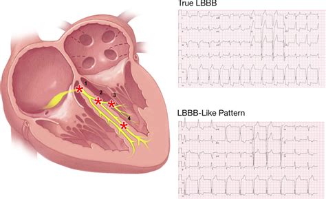 Left Bundle Branch Block With St Elevation My XXX Hot Girl