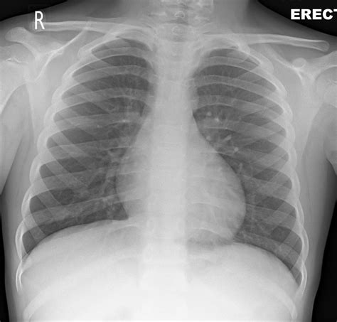 This image shows no abnormality at the left lung base. ACROMIOCLAVICULAR JOINT INJURY | buyxraysonline