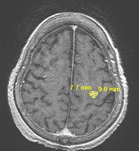 Mri Brain Showing Incidental Brain Metastatic Lesion On 07082021