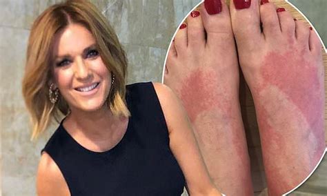 Kylie Gillies Shows Up Close Look At Her Red And Blotchy Feet After