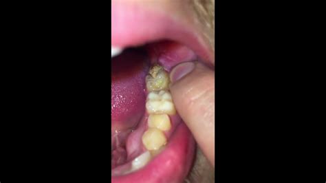 Infection After Wisdom Teeth Removal Youtube