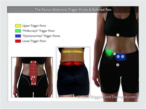 A Diagram Showing The Rectus Abdominis Trigger Points And Their