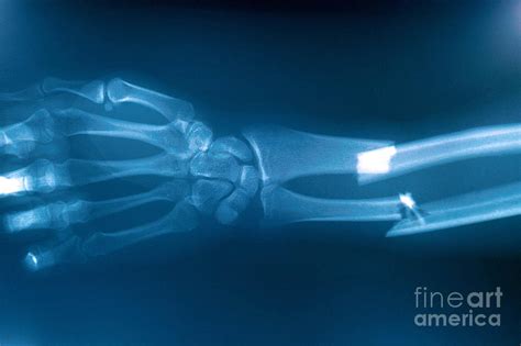 Broken Arm X Ray Photograph By Scott Camazine