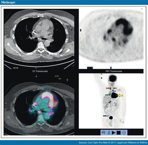 Combined Pet And X Ray Ct Imaging In Pulmonary Infections