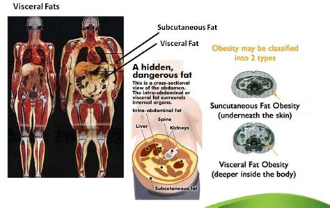 Visceral Fat How The Fat In Your Organs Is Really Killing You 166
