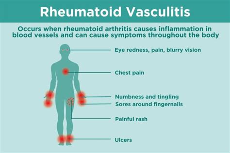 What Is Rheumatoid Vasculitis Symptoms Diagnosis And Treatment