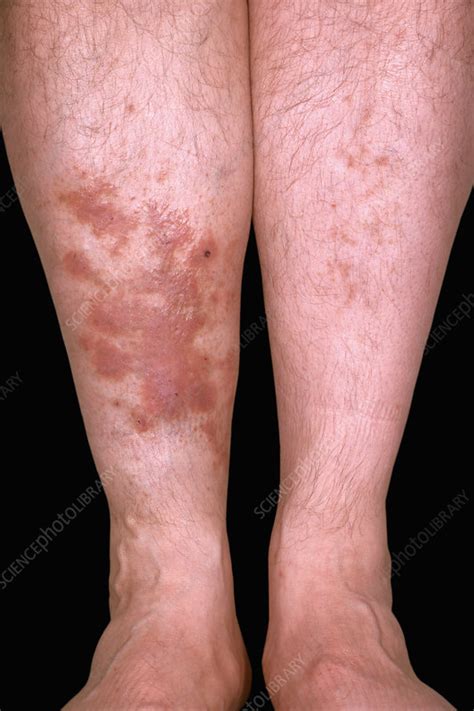 Diabetic Skin Lesions Stock Image C0494452 Science Photo Library