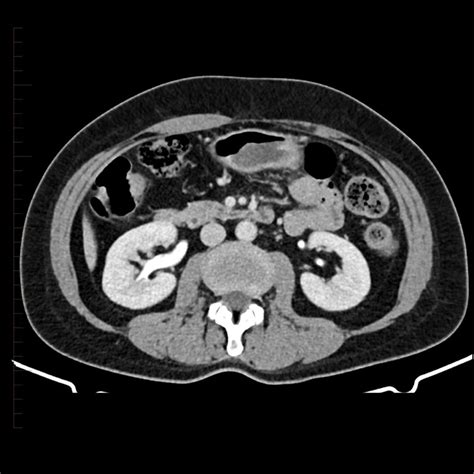 Ct Scan Of The Kidney Diagnostic Imaging Melbourne Radiology