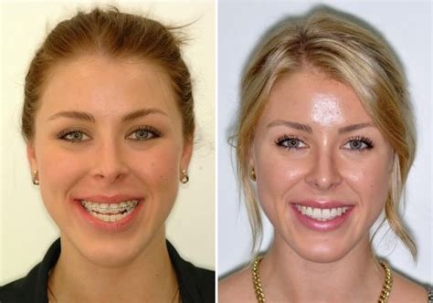 Case 1 Upper And Lower Jaw Surgery Sydney Oral And Facial Surgery