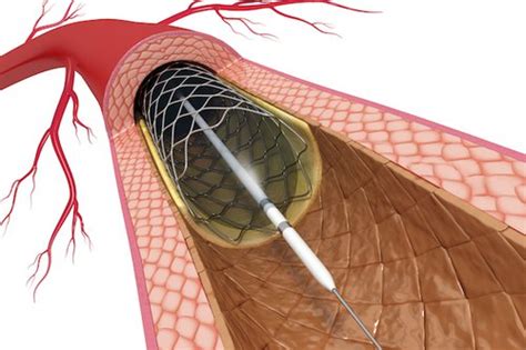 How Pci Stenting Can Reduce Chest Pain And Heart Attack Damage