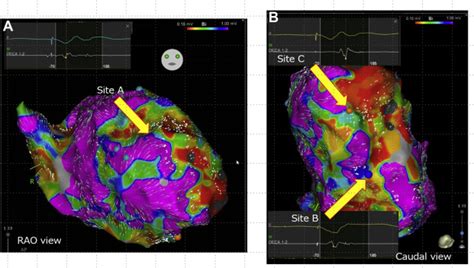 Coherent Mapping Helps Identify Abnormal Potentials And Improves The