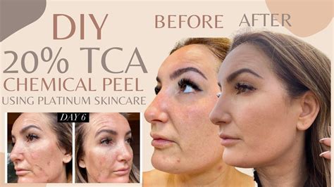 Diy 20 Tca Peel At Homeusing Platinum Skincare Products Youtube