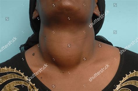 Close Woman Suffering Multinodula Goitre Editorial Stock Photo Stock