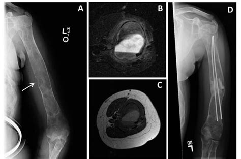 Aneurysmal Bone Cyst ABC Of The Upper Extremity In Fibrous Dysplasia Download Scientific