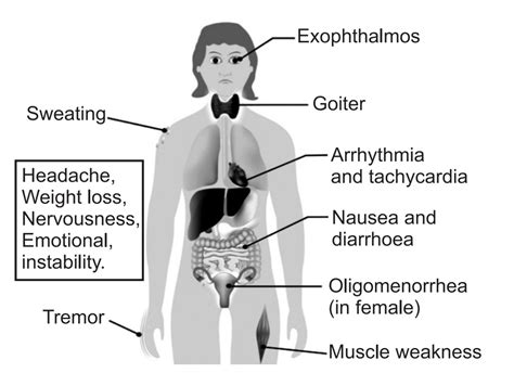 Graves Disease Definition What Is It Symptoms And Treatment