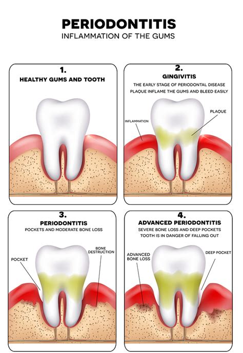 Treat Mouth Infections From Gum Disease Painfree Dr Medina Las Vegas