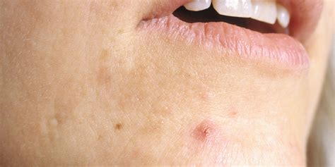 Everything You Ever Wanted To Know About Cystic Acne Huffpost
