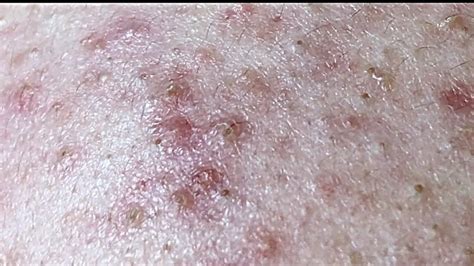 Lancing A Huge Boil On My Leg Pimple Popping Videos