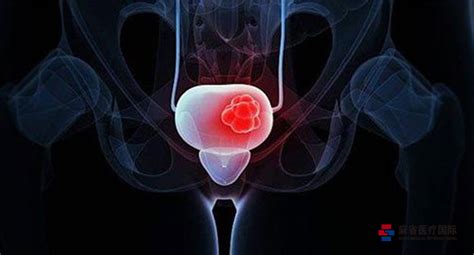 在北美，photofrin(r)还被批准用于治疗更多的适应症，如加拿大和阿根廷批准用于治疗巴来特食管（be）高度异型增生和 膀 胱 乳 头 状癌。 膀胱癌的三种治疗方法|膀胱|治疗|肿瘤|-健康界