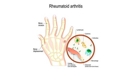 Rheumatoid Arthritis Surgery Options