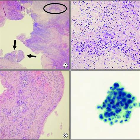 Pdf New Onset Malignant Pleural Effusion After Abscess Formation Of A