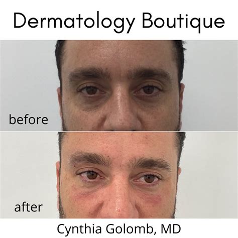 Under Eye Rejuvenation Cynthia Golomb Md Dermatology Boutique