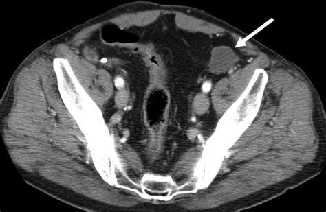 Plugoma Ct Findings After Prosthetic Plug Inguinal Hernia Repairs
