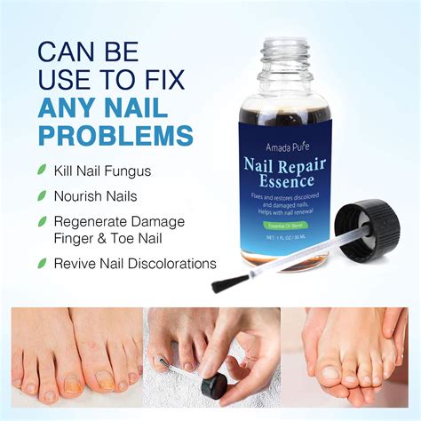 Toenail Fungus Treatment Nail Fungus Treatment Fungus Stop Fingernail Fungus Fungi Nail