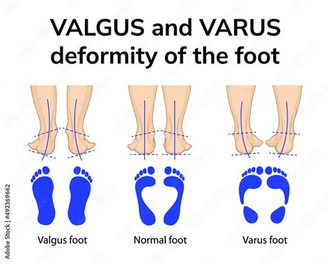 Fototapeta Illustration Of The Position Of The Feet In Varus And Valgus
