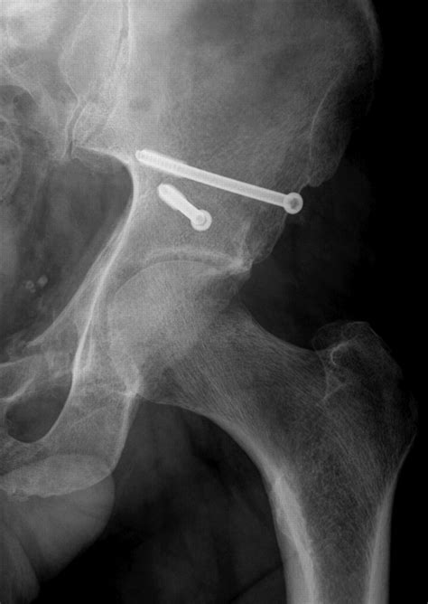 Transverse Acetabular Fracture Hybrid Minimal Access And Percutaneous