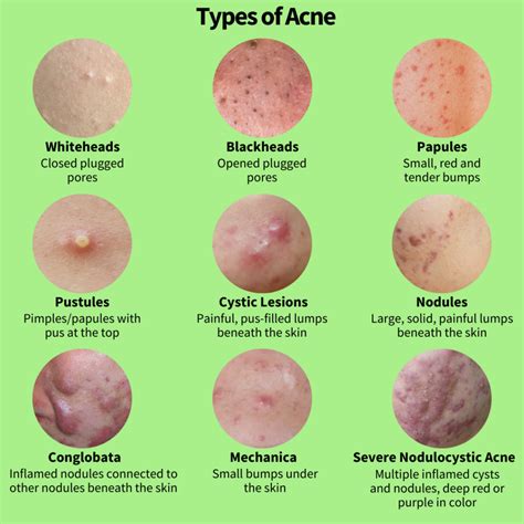 All About Acne Part 1 The Causes Picky Skincare Blog