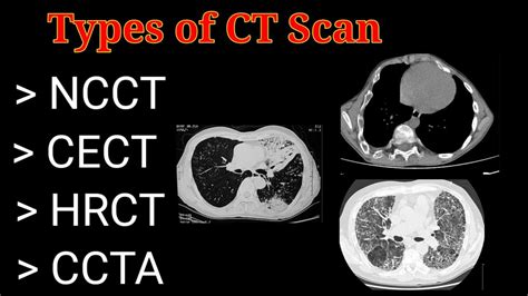 Types Of Ct Scan Ncct Cect Hrct Ccta By Bl Kumawat Youtube