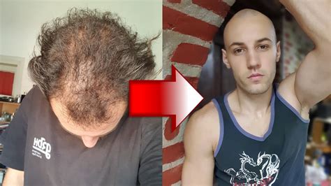 Losing My Hair In My 20s Why I Accepted My Hair Loss Youtube