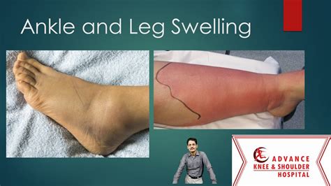 Top 10 Causes Of Ankle And Leg Swelling Youtube