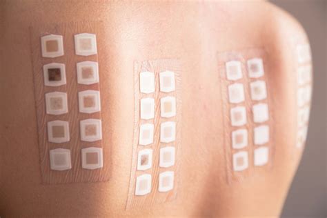 Patch Testing Allergen Skin Testing Epiphany Dermatology