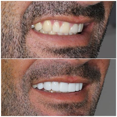 Porcelain Veneers Brisbane Free Consult Smiling Dental