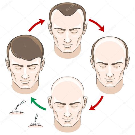 The level of hair loss though will be dependent on some very key factors. Stages of hair loss, treatment and transplantation — Stock ...