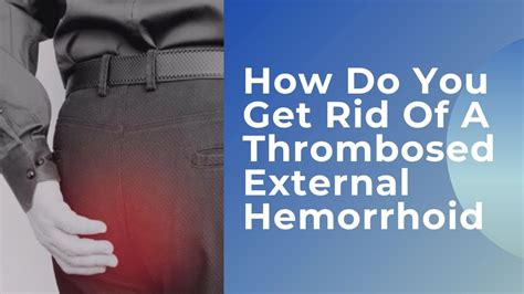 How Do You Get Rid Of A Thrombosed External Hemorrhoid Hemorrhoids