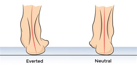 Changing one's shoes is often the first piece of advice podiatrists and physical therapists will give to those in pain because of their flat feet. Guide to Fix Flat Feet - Fix Flat Feet