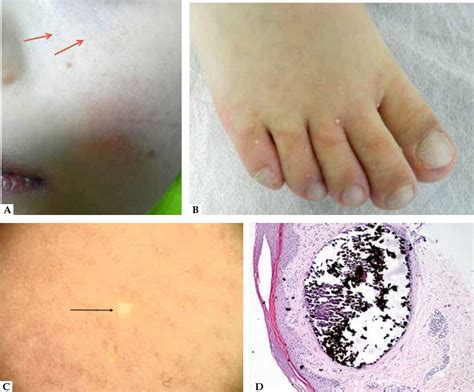 Scielo Brasil Milia Like Calcinosis Cutis In A Girl With Down