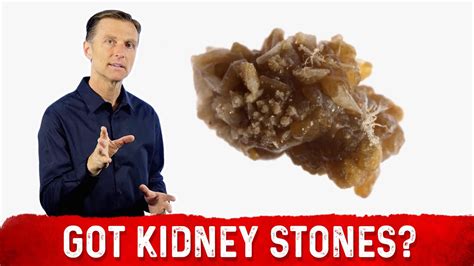 Treatment For Kidney Stone And Kidney Stone Prevention Dr Berg Youtube