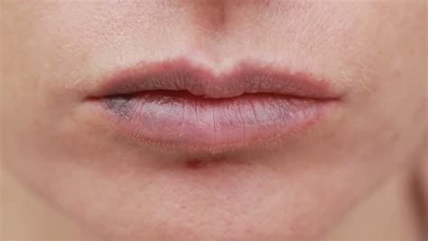 Female Lips Bruise Close Up Effects Hyaluronic の動画素材（ロイヤリティフリー