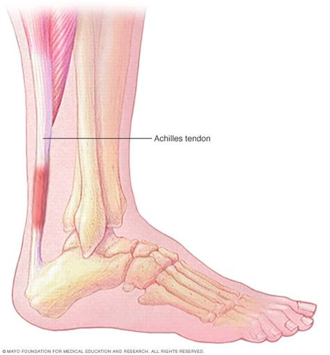 Achilles Tendinitis Disease Reference Guide